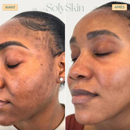 Soin Nettoyant Anti-Imperfections au Curcuma