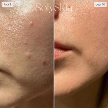 Soin LED Anti-Imperfections