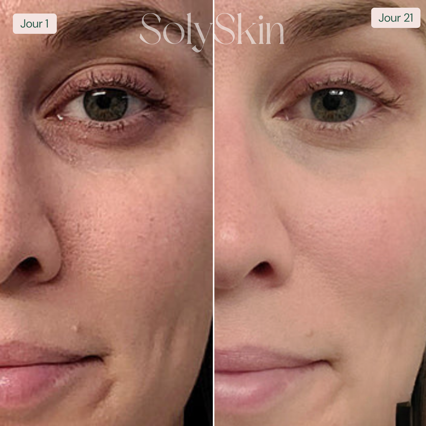 Soin LED Anti-Imperfections