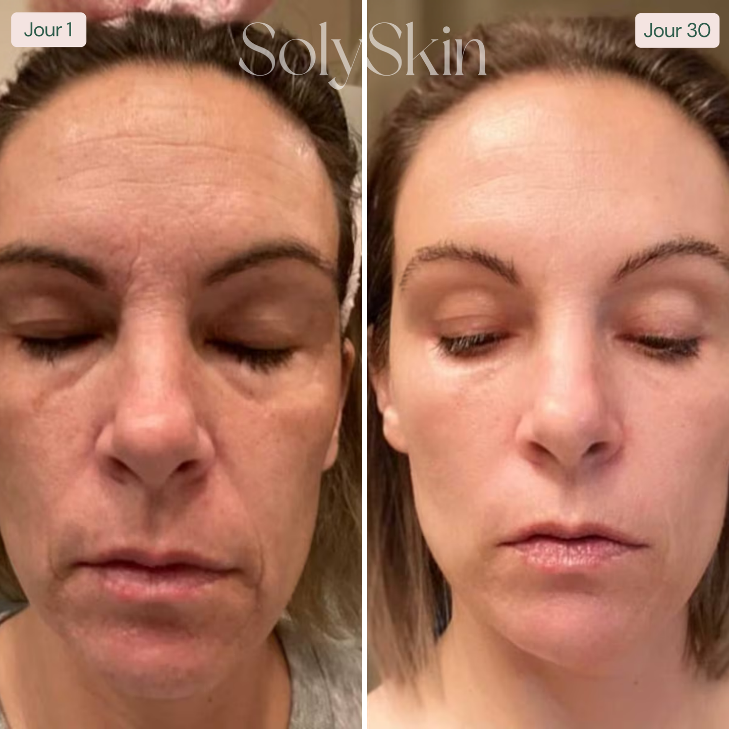 Soin LED Anti-Imperfections