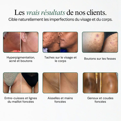 Soin Nettoyant Anti-Imperfections au Curcuma